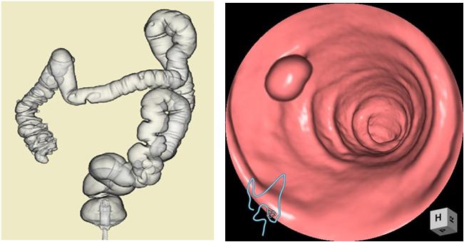 大腸CT検査（CTコロノグラフィ）その2－東邦鎌谷病院